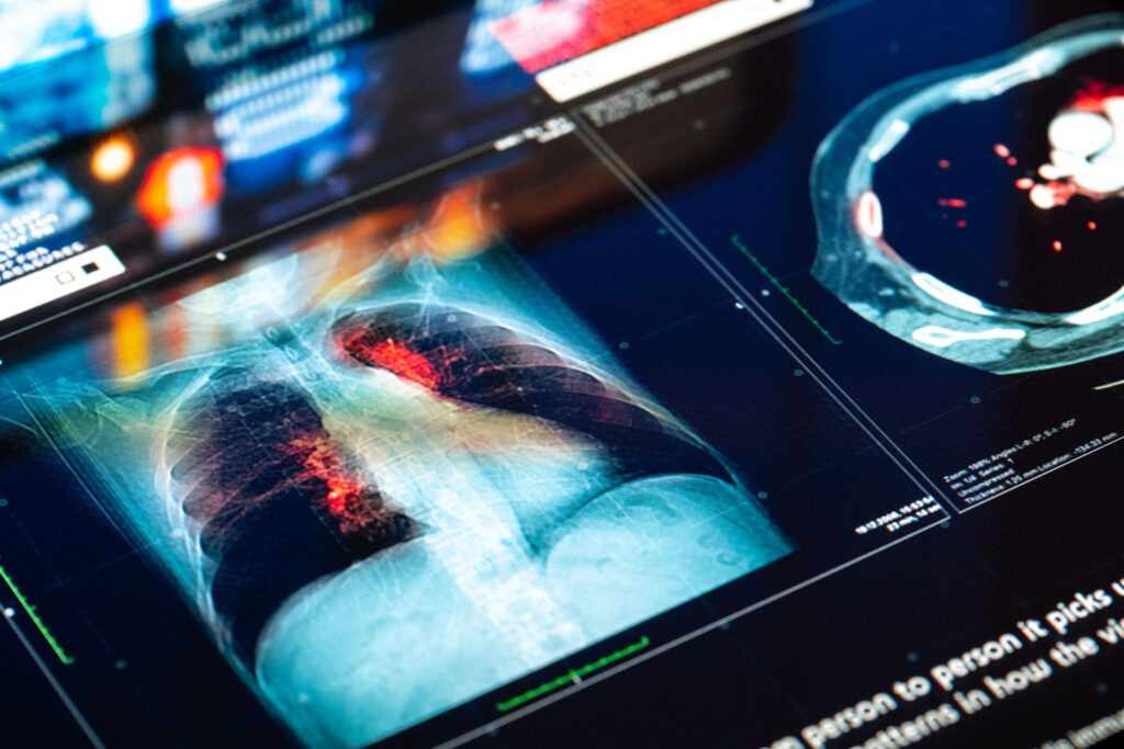 Lung scan